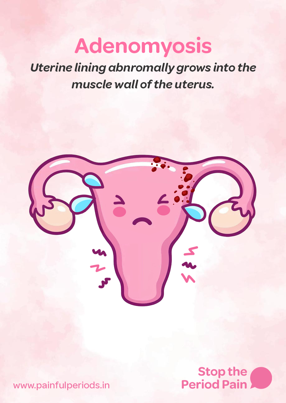 Illustration depicting adenomyosis, a condition where the uterine lining abnormally grows into the muscle wall of the uterus, leading to severe menstrual pain and other adenomyosis symptoms. The background features a soft pink watercolor texture. At the top, the word "Adenomyosis" appears in bold pink text, followed by a description in black italicized font that reads, "Uterine lining abnormally grows into the muscle wall of the uterus." The central cartoon-style image shows a pink uterus with a sad facial expression, tears near the fallopian tubes, and red spots on the upper right side representing abnormal tissue growth. Wavy red and black lines around the uterus symbolize cramps and pelvic pain, common in painful periods caused by adenomyosis. The uterus has arms that are holding the ovaries, which also appear distressed. At the bottom left is the website "www.painfulperiods.in," and in the bottom right corner, a pink speech bubble appears next to the phrase "Stop the Period Pain" in bold pink text, highlighting a call to action for those suffering from chronic period pain and seeking help for their uterine health. The graphic portrays the campaign message "STOP The Period Pain." Which is a knowledge initiative campaign by Blue Cross Laboratories the makers of meftal spas.