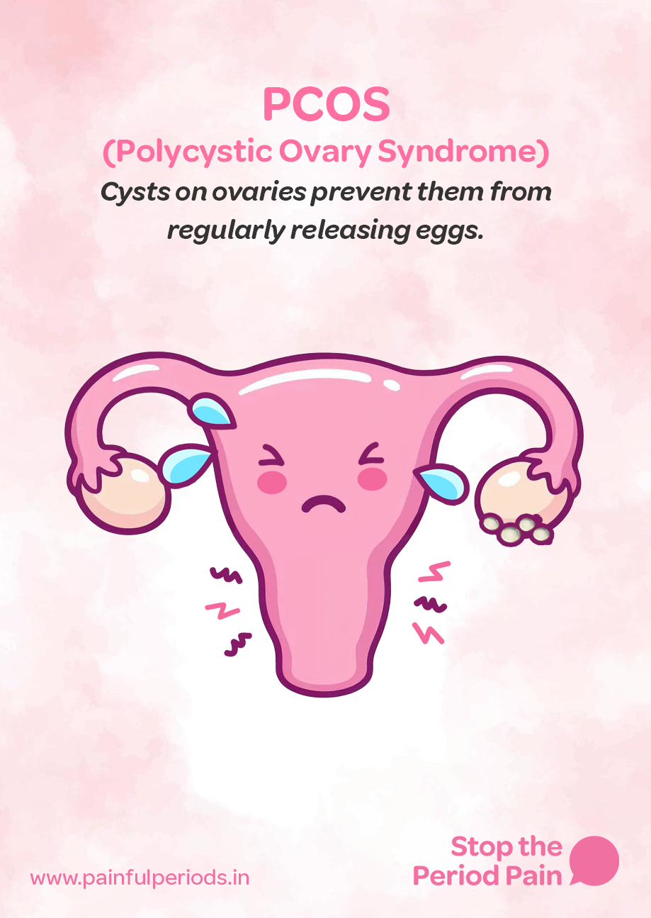 A pink, cartoon-style illustration of a uterus with PCOS showing a sad facial expression and teardrops under its eyes, symbolizing discomfort. Both ovaries are depicted with multiple small ovarian cysts, representing Polycystic Ovary Syndrome. The right ovary (on the left side of the image) has 5 visible cysts, and the left ovary (on the right side) has 6 cysts. Wavy lines and lightning bolt symbols near the lower part of the uterus suggest pelvic pain or cramping, common symptoms of PCOS in women. The background features a soft pink watercolor texture. At the top, bold text reads: “PCOS (Polycystic Ovary Syndrome)”. Below, in smaller text: “Cysts on ovaries prevent them from regularly releasing eggs,” indicating irregular periods and potential fertility issues due to PCOS. At the bottom right corner, a logo says “Stop the Period Pain” with a pink speech bubble icon. The website “**www.painfulperiods.in**” is written in pink in the bottom left corner. The graphic portrays the campaign message "STOP The Period Pain." Which is a knowledge initiative campaign by Blue Cross Laboratories the makers of meftal spas.