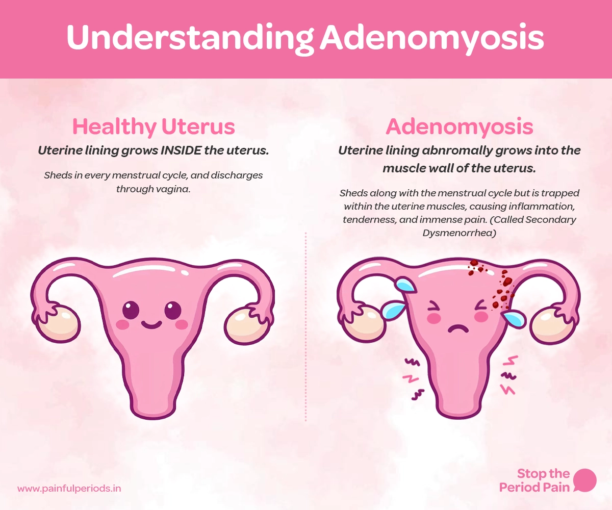 This educational infographic titled "Understanding Adenomyosis" compares a healthy uterus vs adenomyosis using cartoon-style illustrations. On the left, a normal uterus is depicted as a smiling pink organ with a smooth surface and clearly visible ovaries. The caption explains that in a healthy uterus, the uterine lining grows inside the uterus, sheds with every menstrual cycle, and exits through the vaginal canal. On the right, the uterus with adenomyosis symptoms is shown with a frowning face, sweat droplets, and red patches inside the uterine muscle wall, symbolizing inflammation and menstrual pain. The caption explains that in adenomyosis, the endometrial tissue grows into the muscle wall of the uterus and becomes trapped, shedding with each cycle but causing chronic pelvic pain, severe cramps, and heavy periods—a condition referred to as secondary dysmenorrhea. The graphic ends with the campaign message "STOP The Period Pain." Which is a knowledge initiative campaign by Blue Cross Laboratories the makers of meftal spas., with the website www.painfulperiods.in