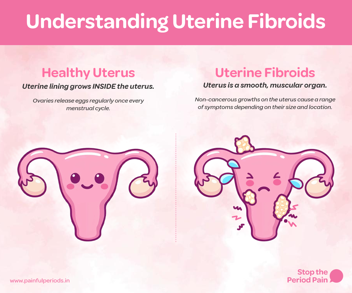 This educational infographic titled "Understanding Uterine Fibroids" visually compares a healthy uterus with a uterus affected by fibroids. On the left side, a happy, cartoon-style healthy uterus anatomy is shown with a smooth pink structure and symmetrical fallopian tubes and ovaries. The text explains that in a healthy uterus, the uterine lining grows inside the uterus and that ovaries release eggs regularly with each menstrual cycle. On the right side, a sad, cartoon fibroid uterus is depicted with multiple yellowish, textured growths on different parts of the uterus, indicating uterine fibroids. Blue teardrop shapes represent pelvic pain or menstrual discomfort. The accompanying text explains that the uterus is a smooth, muscular organ, and that fibroids are non-cancerous growths that cause various symptoms depending on their size and location. The image promotes fibroid awarenessThe graphic ends with the campaign message "STOP The Period Pain." Which is a knowledge initiative campaign by Blue Cross Laboratories the makers of meftal spas.