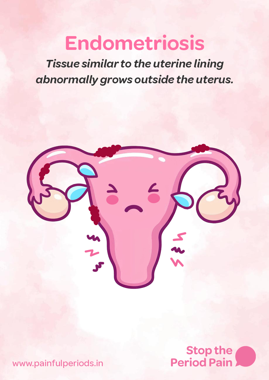 Illustration highlighting endometriosis symptoms and painful periods. The central image is a cartoon-style female reproductive system showing the uterus, ovaries, and fallopian tubes, with a sad facial expression, teary eyes, and red marks indicating pelvic pain. Dark red patches representing endometrial tissue growth outside the uterus are visible on the uterus, fallopian tubes, and ovaries—depicting a classic case of endometriosis disease. Pain indicators like squiggly lines and "Zzz" marks surround the uterus to emphasize chronic period pain. At the top, the text reads: “Endometriosis” in bold pink letters, followed by a description in black italics: “Tissue similar to the uterine lining abnormally grows outside the uterus.” At the bottom right, there's a pink speech bubble with the words “Stop the Period Pain,” supporting awareness for severe menstrual cramps and period pain treatment. Bottom left includes the website link: www.painfulperiods.in. The background is a soft pink watercolor texture, maintaining a gentle and supportive tone. The graphic portrays the campaign message "STOP The Period Pain." Which is a knowledge initiative campaign by Blue Cross Laboratories the makers of meftal spas.