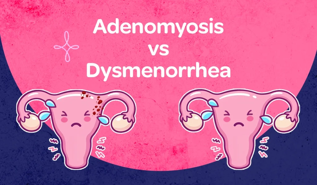 A comparison table titled “Adenomyosis vs Regular Period Pain” (comparison of adenomyosis symptoms vs dysmenorrhea symptoms and painful periods) shows differences across symptoms, with three columns labeled Symptom, Adenomyosis, and Period Pain (Dysmenorrhea). It explains that adenomyosis is caused by the uterine lining growing into the wall of the uterus (adenomyosis causes), while period pain is caused by excess prostaglandins that trigger uterine contractions (menstrual cramps). Bleeding in adenomyosis is very heavy (heavy menstrual bleeding) with clots larger than a 2-cent coin and periods often last longer than 7 days (long menstrual cycles), whereas period pain typically involves moderate to heavy bleeding lasting 3 to 5 days. Pain in adenomyosis is described as heavy, dragging, and constant pressure (chronic pelvic pain), with pelvic tenderness or fullness even between periods, while period pain causes sharp, wave-like cramps (period cramps) with no discomfort between cycles. Relief for adenomyosis requires long-term medical management (adenomyosis treatment), while period pain usually responds well to NSAIDs (period pain relief). Additional symptoms of adenomyosis include an enlarged uterus, chronic pelvic pain, pain during intercourse, bloating, and infertility, whereas period pain may include blood clots, mood swings, bloating, nausea, vomiting, lightheadedness, pain radiating to the lower back or thighs (lower back pain during periods), loose bowel movements, and constipation. The graphic portraits the campaign message "STOP The Period Pain." Which is a knowledge initiative campaign by Blue Cross Laboratories the makers of meftal spas