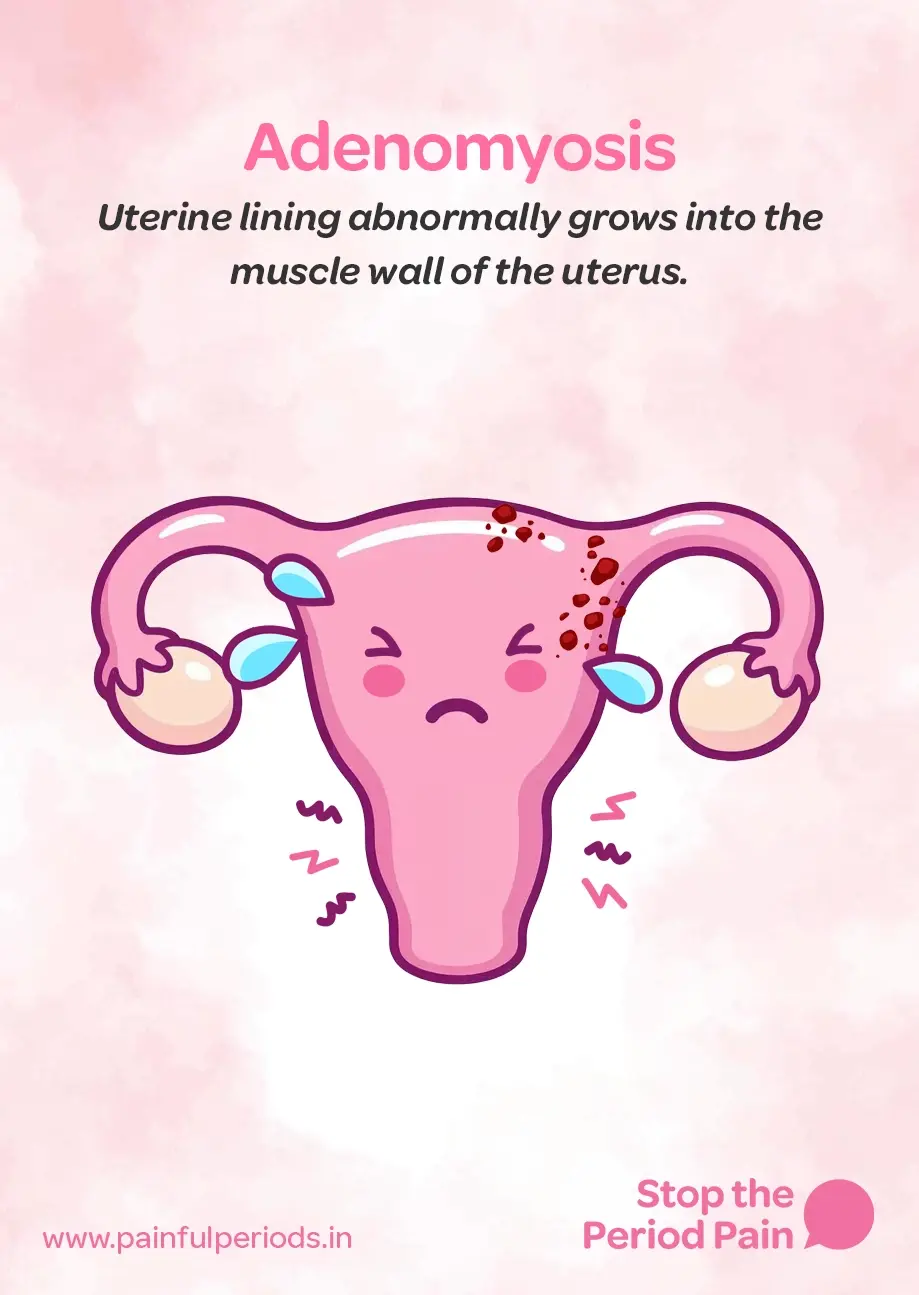 Illustration depicting adenomyosis, a condition where the uterine lining abnormally grows into the muscle wall of the uterus, leading to severe menstrual pain and other adenomyosis symptoms. The background features a soft pink watercolor texture. At the top, the word "Adenomyosis" appears in bold pink text, followed by a description in black italicized font that reads, "Uterine lining abnormally grows into the muscle wall of the uterus." The central cartoon-style image shows a pink uterus with a sad facial expression, tears near the fallopian tubes, and red spots on the upper right side representing abnormal tissue growth. Wavy red and black lines around the uterus symbolize cramps and pelvic pain, common in painful periods caused by adenomyosis. The uterus has arms that are holding the ovaries, which also appear distressed. At the bottom left is the website "www.painfulperiods.in," and in the bottom right corner, a pink speech bubble appears next to the phrase "Stop the Period Pain" in bold pink text, highlighting a call to action for those suffering from chronic period pain and seeking help for their uterine health. The graphic portrays the campaign message "STOP The Period Pain." Which is a knowledge initiative campaign by Blue Cross Laboratories the makers of meftal spas.